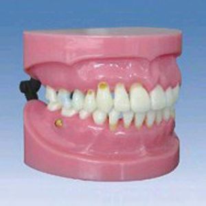 Periodontal lesions demo model